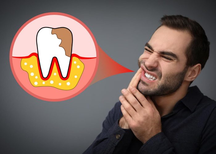 consejos para prevenir la aparición de caries