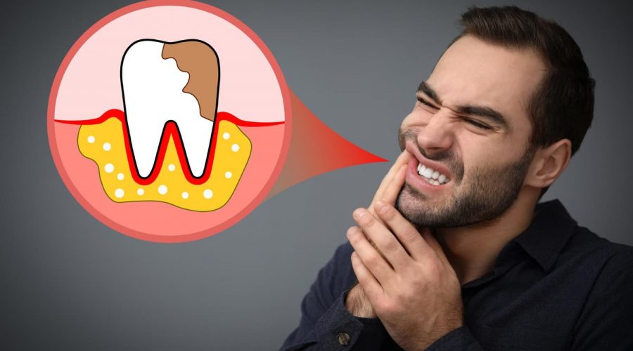 consejos para prevenir la aparición de caries